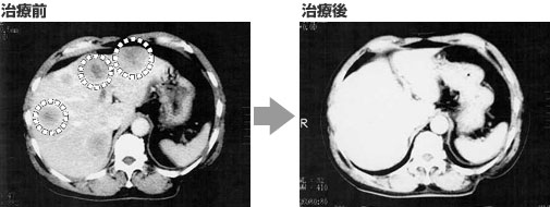肺癌(肺がん)⇒肝臓へ転移(肝臓がん) 治療の経過