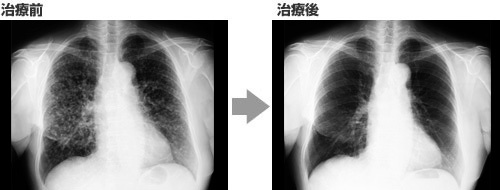 症例1：肺癌（肺がん） 治療の経過