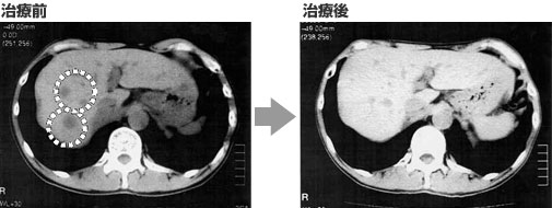 癌 余命 大腸 肺 転移 「私はどれだけ生きられる？」がん患者の余命とは何か｜教えて！けいゆう先生｜時事メディカル｜時事通信の医療ニュースサイト